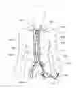 Fig. 01 - Expandable iliac sheath and method of use