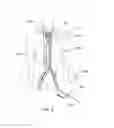 Fig. 09 - Expandable iliac sheath and method of use