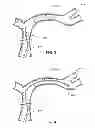 Fig. 04 - Thrombectomy device with distal protection