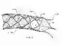 Fig. 07 - Thrombectomy device with distal protection