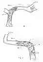 Fig. 08 - Thrombectomy device with distal protection
