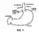 Fig. 02 - Tissue fastening devices and related insertion tools and methods