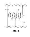 Fig. 04 - Tissue fastening devices and related insertion tools and methods