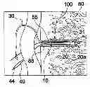 Fig. 01 - Systems for locking a cinch loop in tissue repair