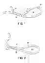 Fig. 02 - Systems for locking a cinch loop in tissue repair