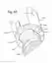 Fig. 22 - POLYAXIAL BONE ANCHOR WITH POP-ON MULTI-THREAD SHANK, SOME WITH DIAMETRIC INTERFERENCE FIT INSERTS