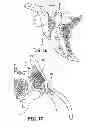 Fig. 08 - Methods for delivery of screws for joint fusion
