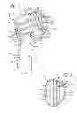 Fig. 03 - System and method for fracture replacement of comminuted bone fractures or portions thereof adjacent bone joints