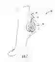 Fig. 02 - Percutaneous tibial nerve stimulator
