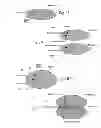 Fig. 02 - SYSTEMS AND METHODS TO PLACE ONE OR MORE LEADS IN MUSCLE FOR PROVIDING ELECTRICAL STIMULATION TO TREAT PAIN
