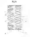 Fig. 07 - Fixation Process For Nesting Stents