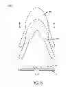 Fig. 06 - Stent with varying cross-section