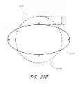 Fig. 35 - Revascularization devices