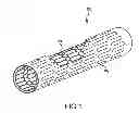 Fig. 02 - Post-implantation contractible or expandable devices and method of using and making the same