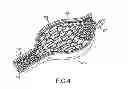 Fig. 04 - Post-implantation contractible or expandable devices and method of using and making the same