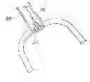 Fig. 01 - Methods for transluminal delivery of prosthetic valves