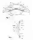 Fig. 02 - ACCOMMODATING INTRAOCULAR LENS WITH CILIARY BODY ACTIVATION