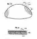 Fig. 13 - INFLATABLE PROSTHESES AND METHODS OF MAKING SAME