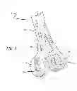 Fig. 02 - Bone joint replacement and repair assembly and method of repairing and replacing a bone joint