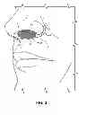 Fig. 03 - Nostril Filtration Assembly