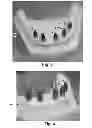Fig. 04 - DEVICE FOR INDICATING THE POSITION AND ORIENTATION OF A DENTAL IMPLANT