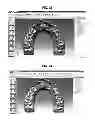 Fig. 16 - Method for manufacturing transparent braces