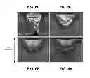 Fig. 07 - Using millisecond pulsed laser welding in MEMS packaging