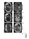 Fig. 06 - Fat and iron quantification using a multi-step adaptive fitting approach with multi-echo magnetic resonance imaging