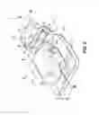 Fig. 03 - Orthodontic bracket having a biased slide member