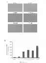 Fig. 06 - Anaplastic thyroid cancers harbor novel oncogenic mutations of the ALK gene