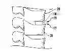 Fig. 01 - Shape memory curable spinal implants
