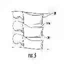 Fig. 04 - Shape memory curable spinal implants