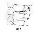 Fig. 06 - Shape memory curable spinal implants