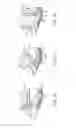 Fig. 09 - Pelvic implant with suspending system
