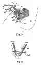 Fig. 03 - Adjustable tension incontinence sling assemblies