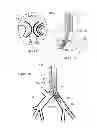 Fig. 02 - Endobronchial tube with integrated image sensor and a cleaning nozzle arrangement