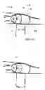 Fig. 10 - Endobronchial tube with integrated image sensor and a cleaning nozzle arrangement
