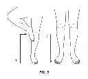 Fig. 05 - Methods for preventing and treating motor related neurological conditions