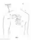Fig. 02 - Detecting worsening heart failure based on fluid accumulation with respiratory confirmatoin