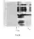 Fig. 09 - Seizure detection and epileptogenic lesion localization