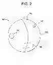 Fig. 03 - MEDICAL DEVICE FOR REMOVING PATHOGENS