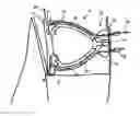 Fig. 01 - HEMODIALYSIS ACCESS PORT AND CLEANING SYSTEM