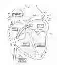Fig. 01 - Methods and apparatus for reducing localized circulatory system pressure