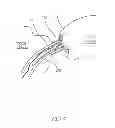Fig. 04 - Methods and apparatus for reducing localized circulatory system pressure