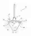 Fig. 01 - Catheter securement via integrated securement strips