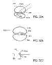 Fig. 14 - Deployment mechanism for body vessel insertion devices