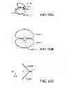 Fig. 15 - Deployment mechanism for body vessel insertion devices