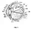 Fig. 02 - APPARATUS AND PROCESSES FOR PREVENTING OR DELAYING ONE OR MORE SYMPTOMS OF PRESBYOPIA