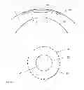 Fig. 04 - Method for eye surgery