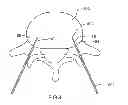 Fig. 08 - Electrosurgical tissue treatment device
